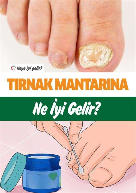 Tırnak mantarına ne iyi gelir?