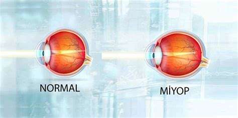 Miyop Nedir: Göz Bozukluğu ve Tedavi Seçenekleri