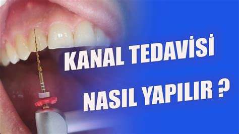 Kanal Tedavisi Nasıl Yapılır: Diş Tedavi Süreci