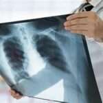 Zatürre Nedir: Akciğer Enfeksiyonu ve Tedavisi