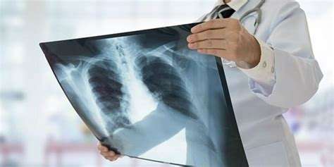 Zatürre Nedir: Akciğer Enfeksiyonu ve Tedavisi