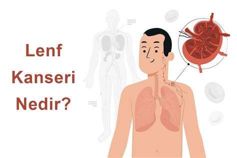 Lenf Kanseri Nedir: Lenf Sistemini Etkileyen Kanser Türü