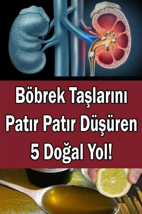 Böbrek Taşı Nasıl Düşer: Taşın Doğal Yollarla Atılması